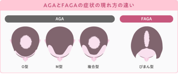 FAGAとAGAの症状の現れ方の違いが分かる画像