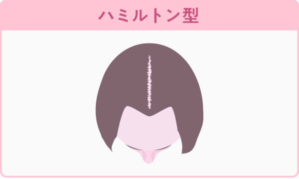FAGAのハミルトン型が分かる画像