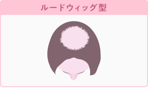 FAGAのルードウィッグ型が分かる画像