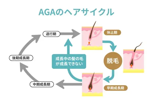 aga発症時のヘアサイクルが分かる画像