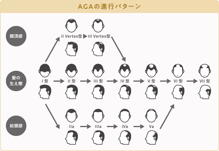 AGAの進行パターン