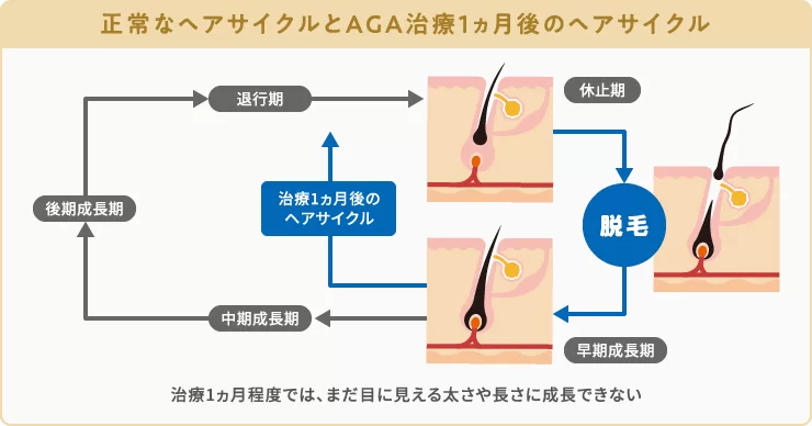 正常なヘアサイクルとAGA治療1ヵ月後のヘアサイクルの違い