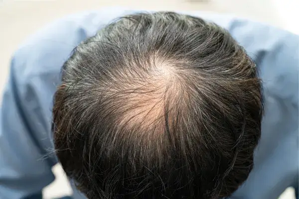 頭頂部の薄毛（つむじはげ）