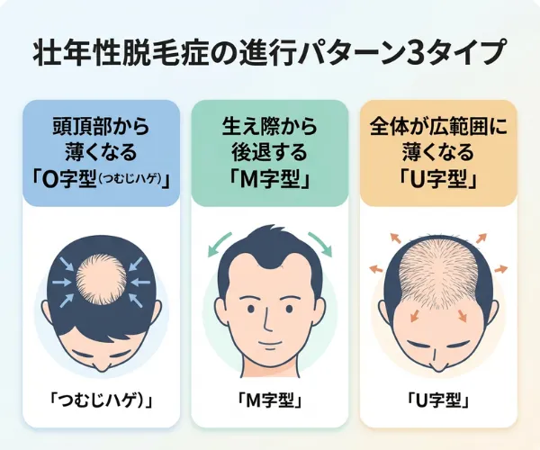 壮年性脱毛症の進行パターン3タイプ