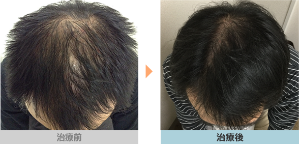 症例写真 Aga 薄毛治療の発毛専門病院 スマイルagaクリニック