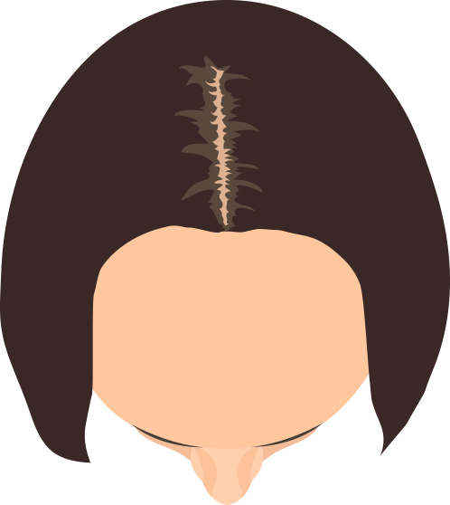 前頭部中心に薄毛が見られるタイプが分かる画像