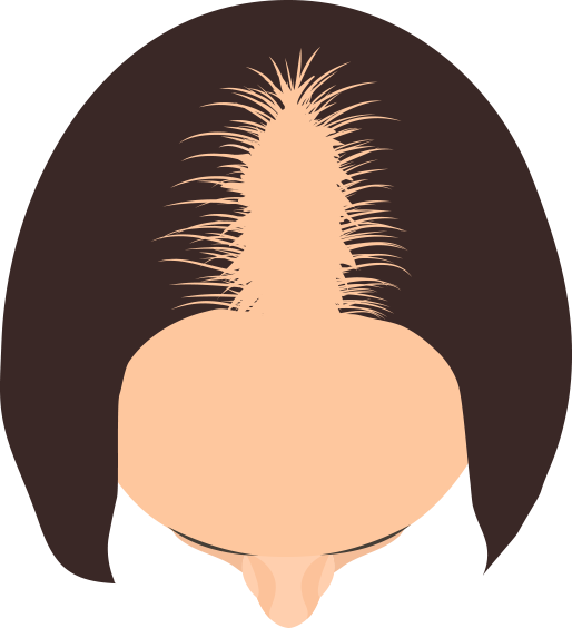 頭部全体に広がるタイプが分かる画像