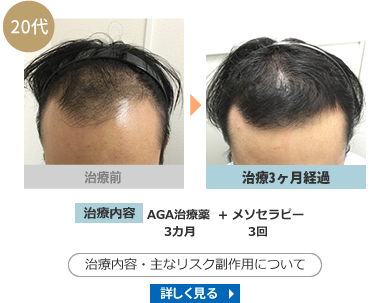 薄毛モニター症例写真 40代