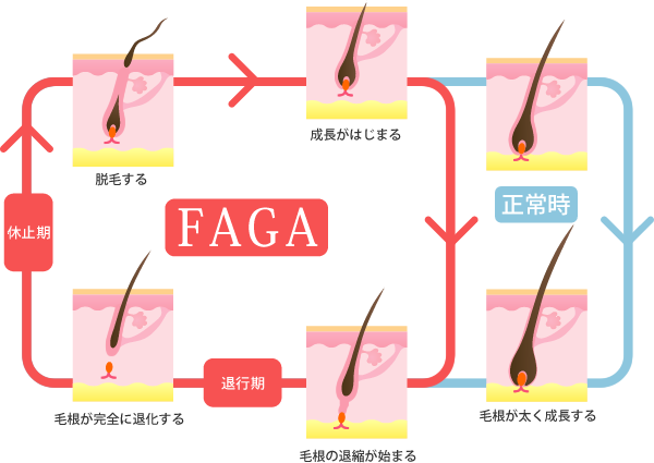 ヘアサイクルの乱れ FAGAイメージ