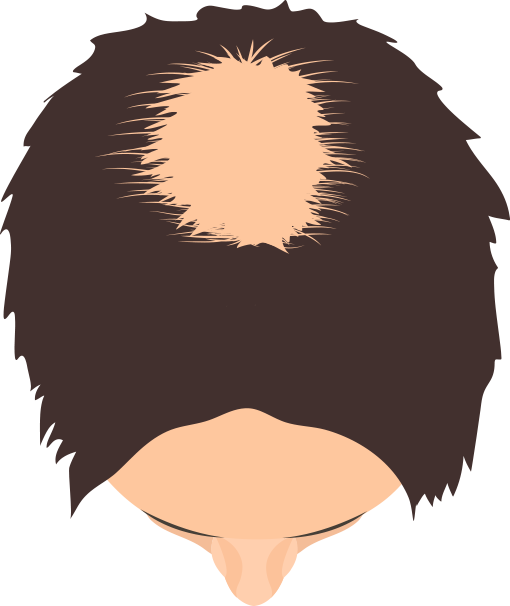 頭頂部から広がるタイプが分かる画像