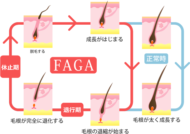 女性の薄毛 Faga 治療 Aga 薄毛治療の発毛専門病院 スマイルagaクリニック 女性の薄毛 Faga 治療 Aga 薄毛治療の発毛専門病院 スマイルagaクリニック